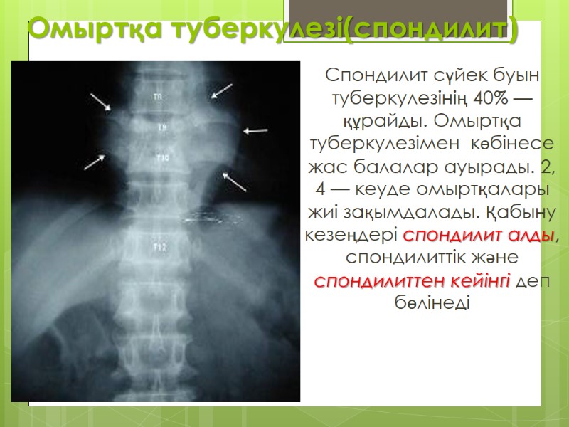 Омыртқа туберкулезі(спондилит) Спондилит сүйек буын туберкулезінің 40% — құрайды. Омыртқа туберкулезімен  көбінесе жас